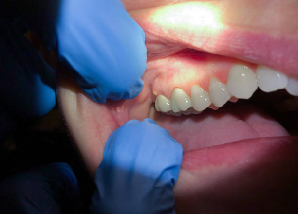 Best Emergency Dental Care for Broken or Chipped Teeth in Colon, MI