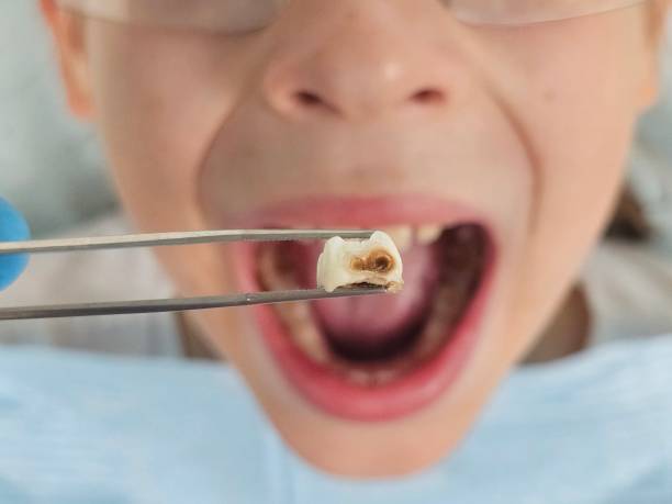 Best Urgent Care for Lost Fillings or Crowns in Colon, MI